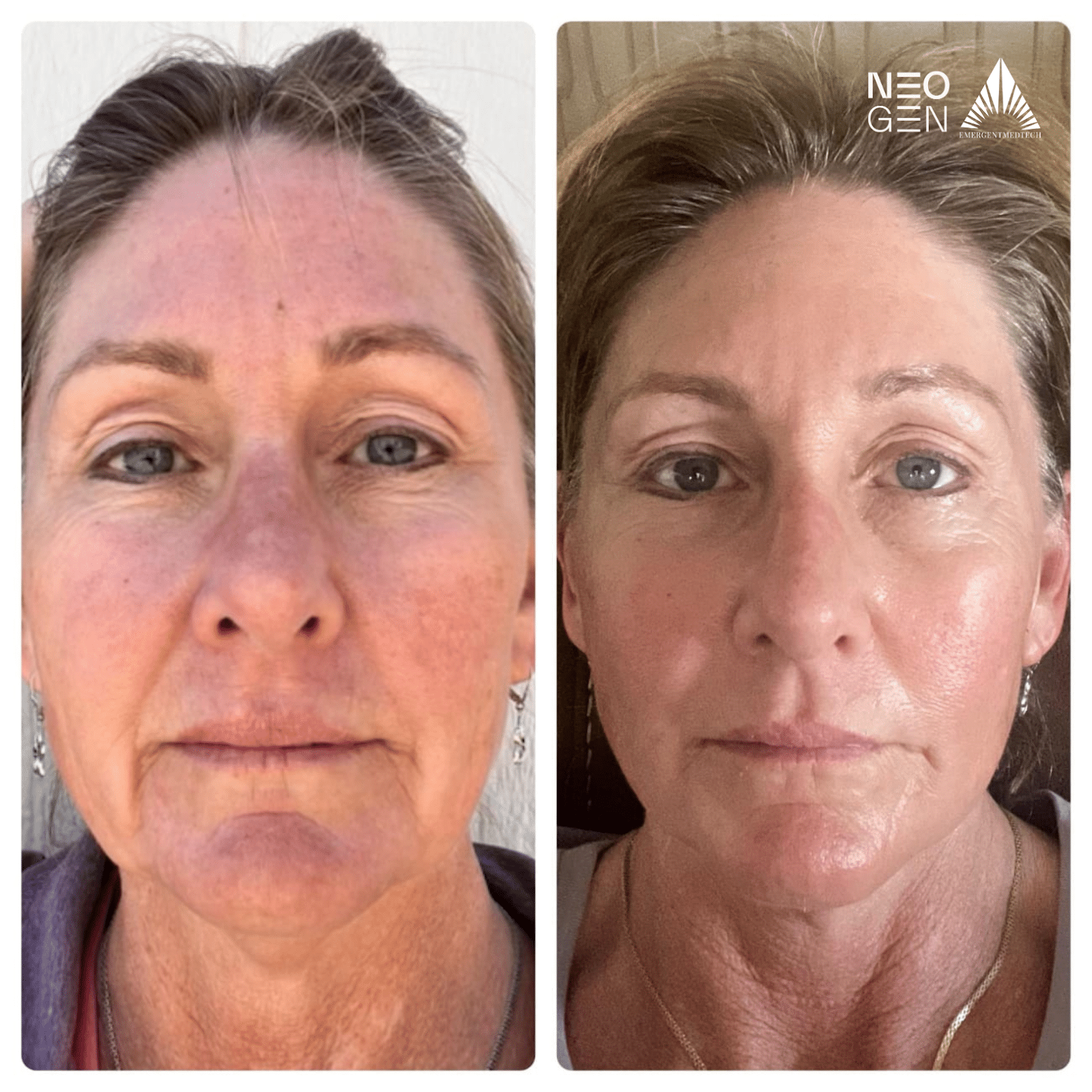 NeoGen before and after